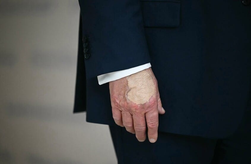 ضمادة على يد ترامب تثير الجدل والبيت الأبيض يبرّر مجددا